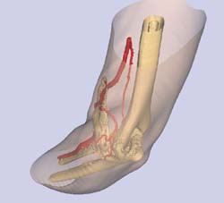 Ectopic bone around Right Elbow