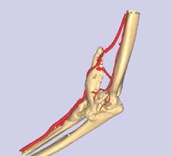 Ectopic bone around Right Elbow