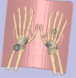 combined the 3D CT data and the bone scan data